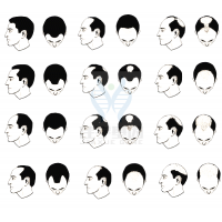 【bbin宝盈基因检测】过早<font color='red'>脱发</font>、掉发太多怎么办？你的方法可能是错的！